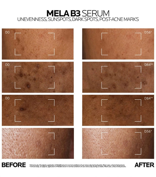 La Roche-Posay Mela B3 Serum – سيروم لتفتيح وتصحيح البقع الداكنة